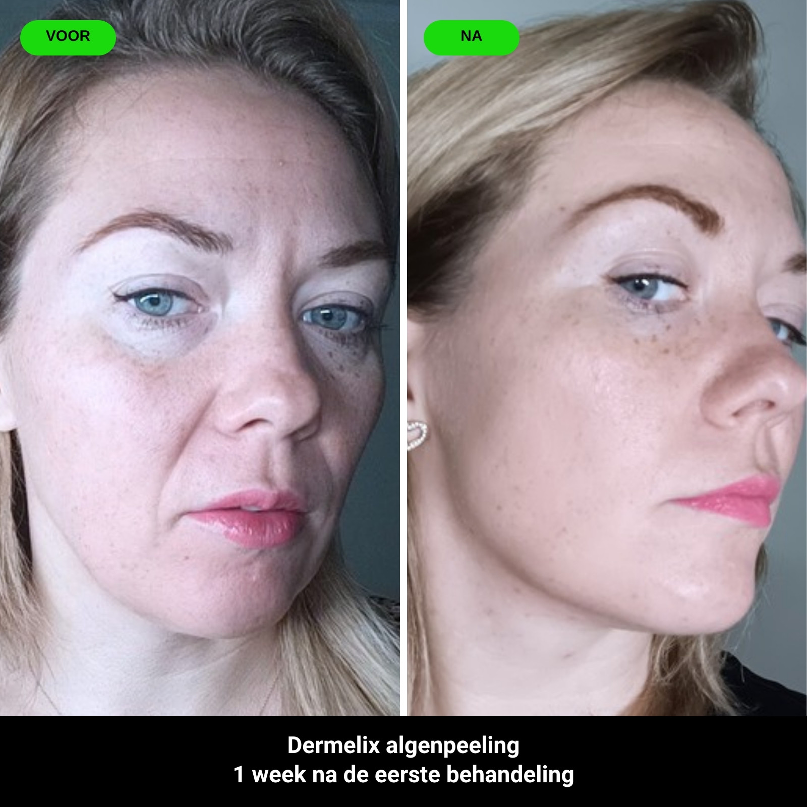 Voor en na: Dermelix algenpeeling, 1 week na de eerste behandeling