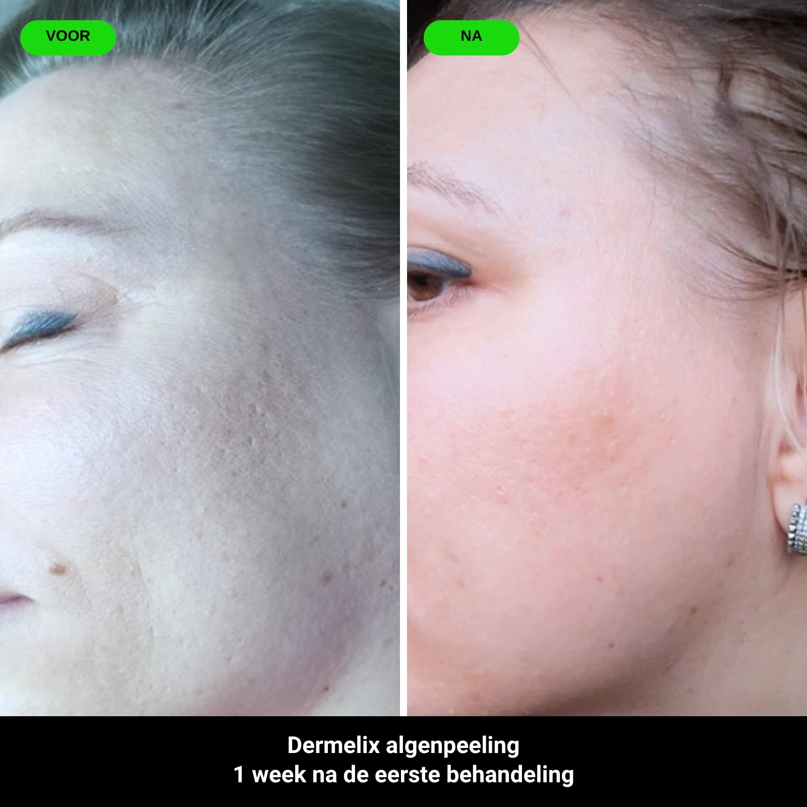 Voor en na: Dermelix algenpeeling, 1 week na de eerste behandeling
