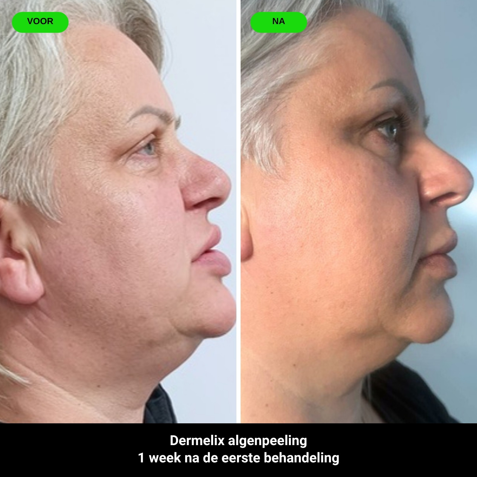 Voor en na: Dermelix algenpeeling, 1 week na de eerste behandeling