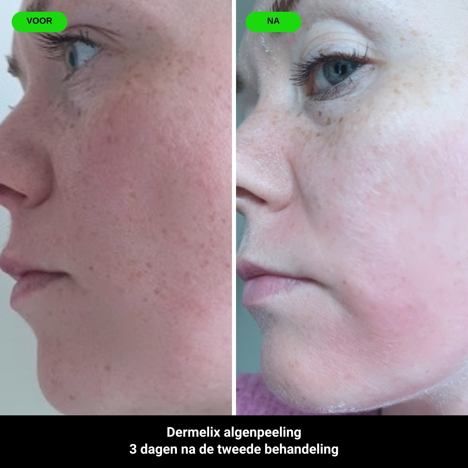 Voor en na: Dermelix algenpeeling, 3 dagen na de tweede behandeling