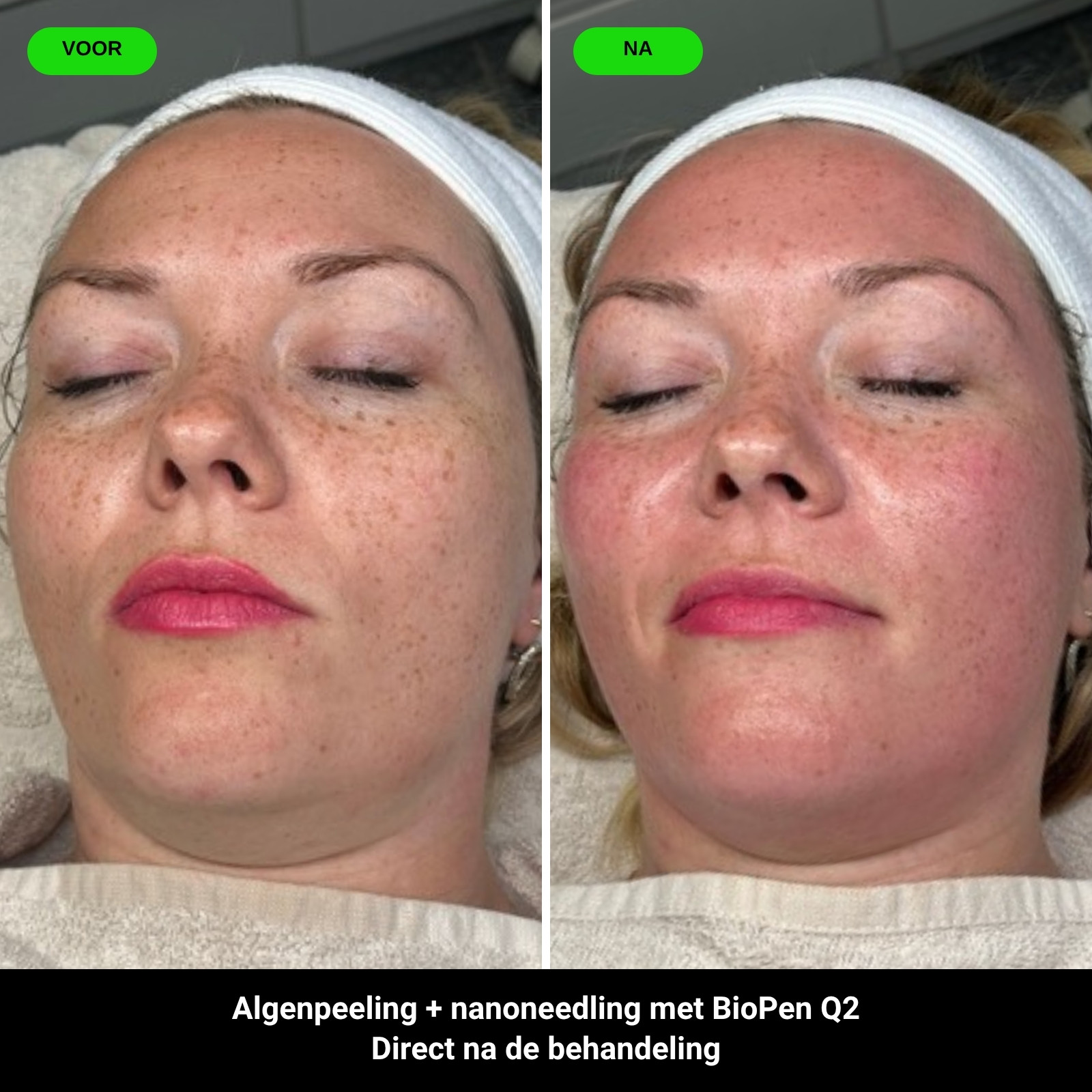 Voor en na: algenpeeling met nanoneedling BioPen Q2, direct na de behandeling