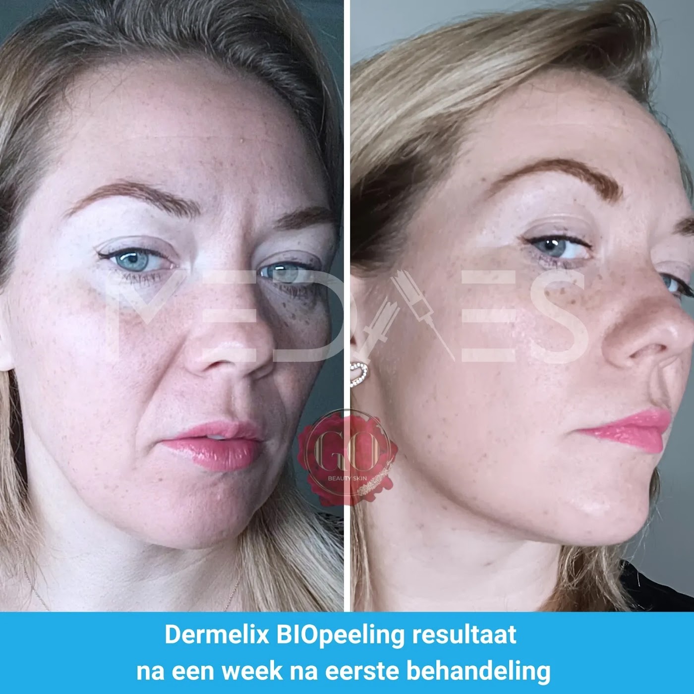 dermelix-resultaat-bp-002-voor-en-na-1-week-m01 Resultaat Dermelix BP-002 algenpeeling: voor en 1 week na de eerste behandeling