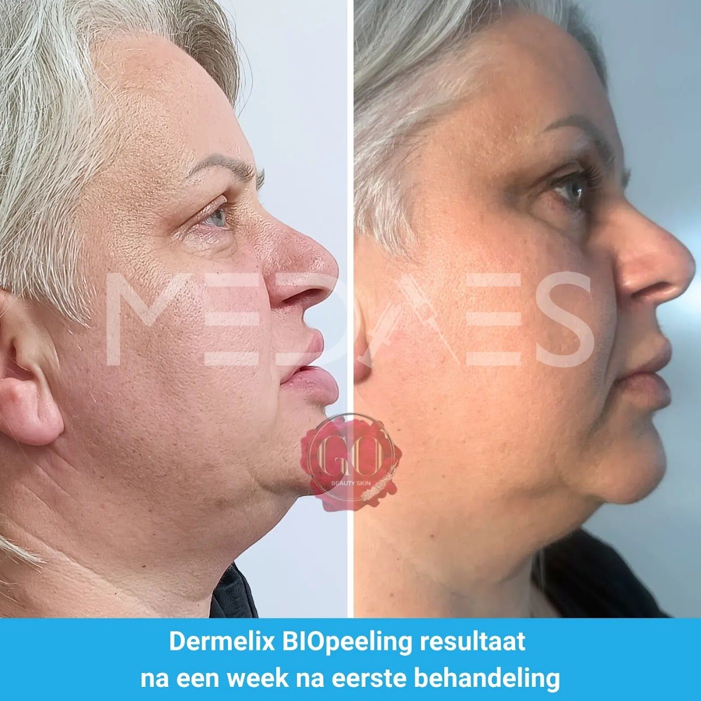 dermelix-resultaat-bp-002-voor-en-na-1-week-m02 Resultaat Dermelix BP-002 algenpeeling: voor en 1 week na de eerste behandeling