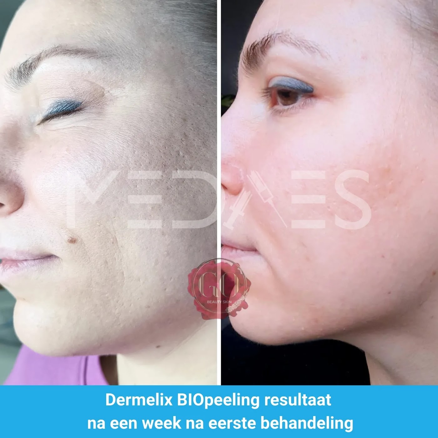 dermelix-resultaat-bp-002-voor-en-na-1-week-m03 Resultaat Dermelix BP-002 algenpeeling: voor en 1 week na de eerste behandeling