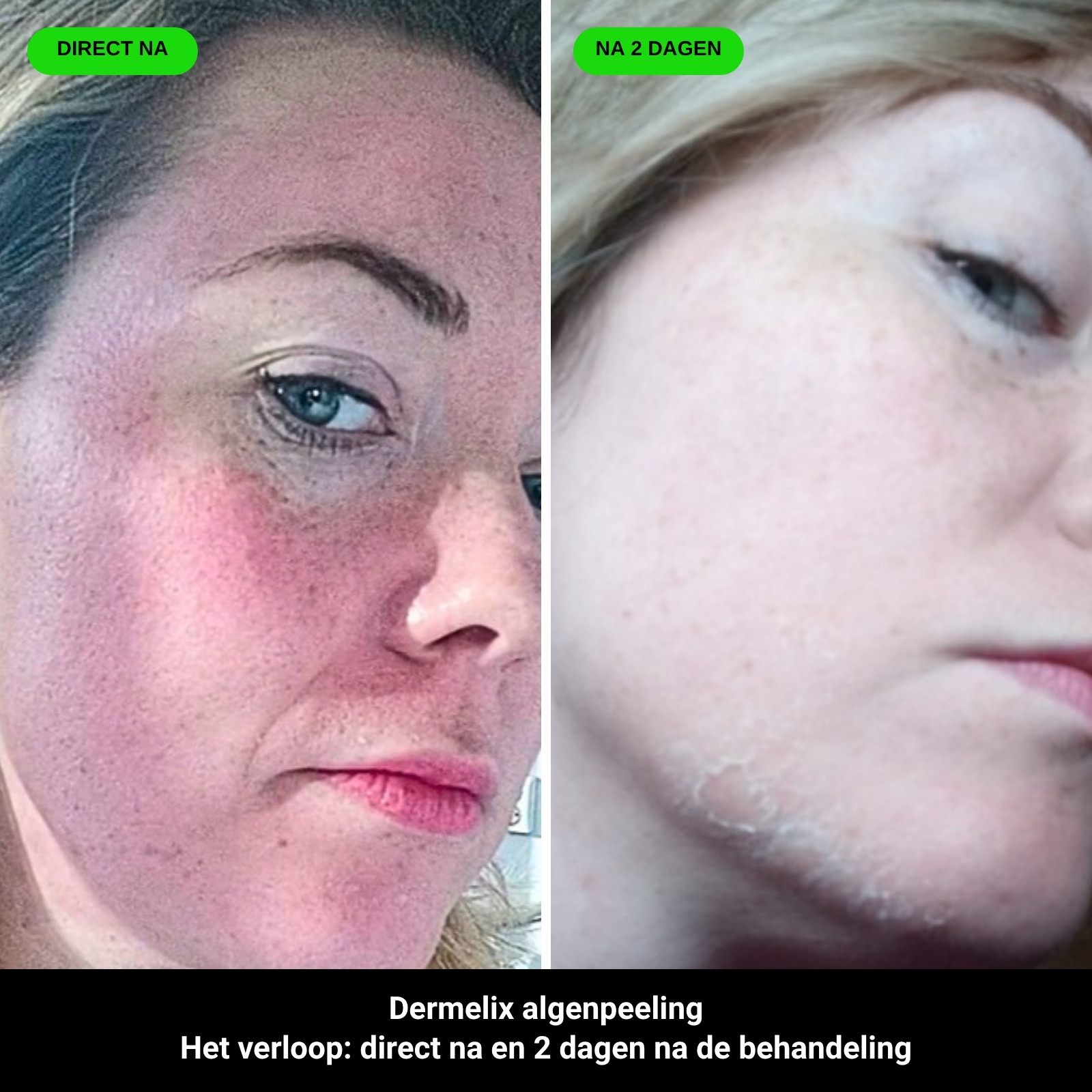 Het verloop: direct na en 2 dagen na de Dermelix algenpeeling
